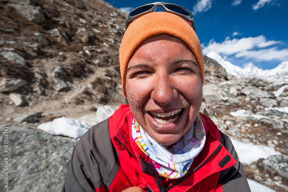 Trekker with burned skin on face is smiling at camera in Khumbu valley on a way to Everest Base camp Trekker with burned skin on face is smiling at camera in Khumbu valley on a way to Everest Base camp