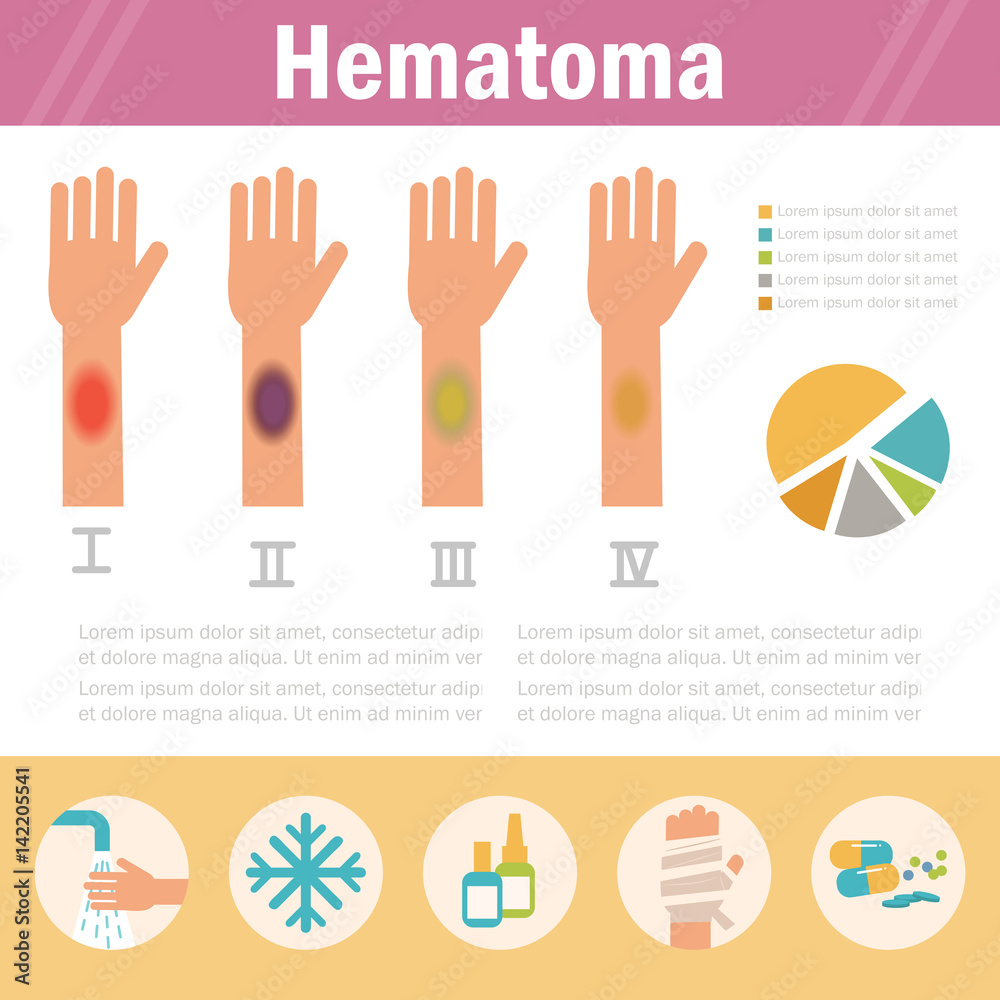 How Long Does A Severe Hematoma Take To Heal