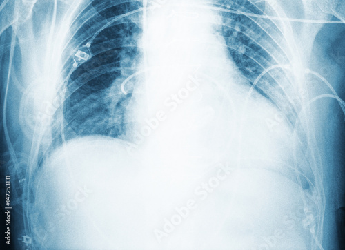 X-ray scan of patient`s chest after surgery