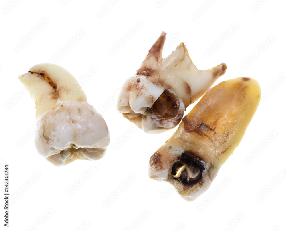 Patients extracted teeth on a white background Patients extracted teeth on a white background