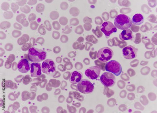 Leukemia blood cells medical science background concept. photo