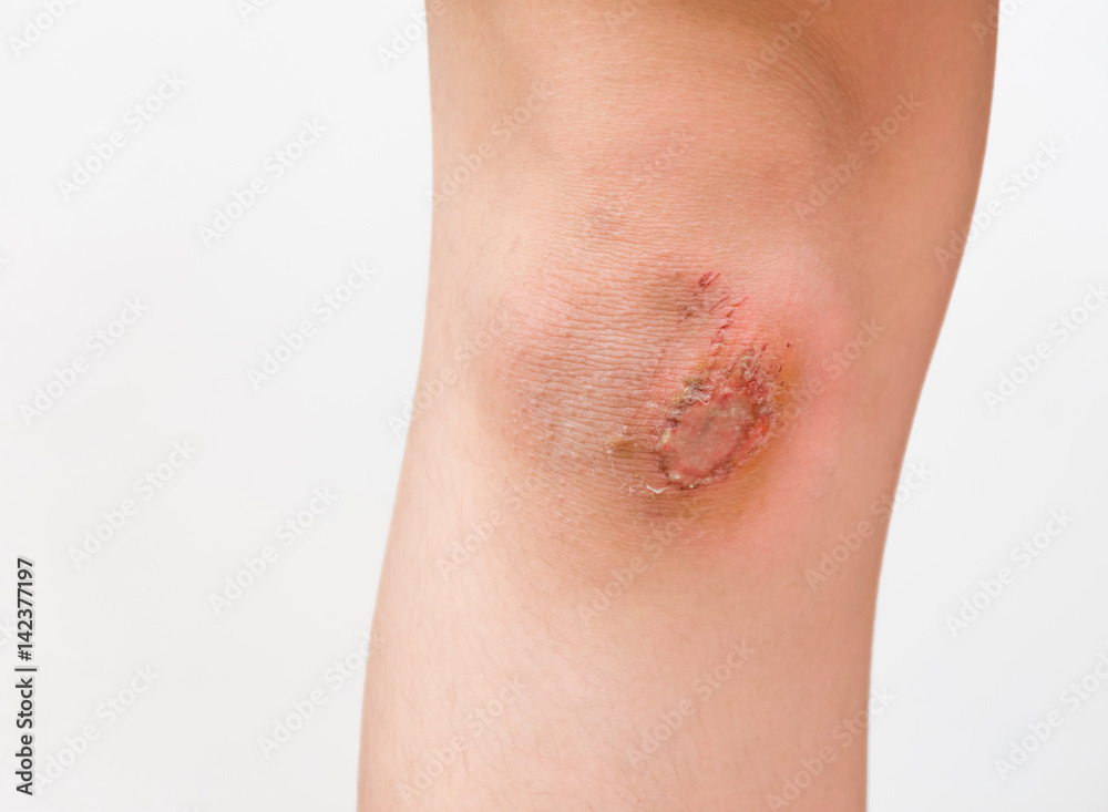 Wound at the knee caused by the fall. Wound at the knee caused by the fall.