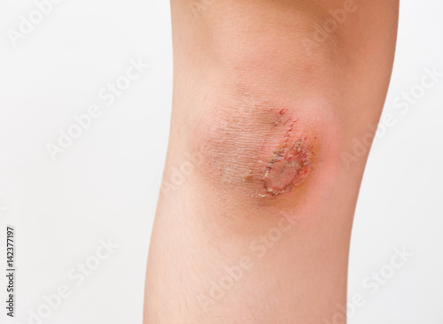Wound at the knee caused by the fall.