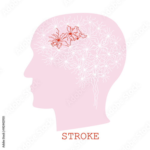 Stroke concept with human head silhouette © greenvector
