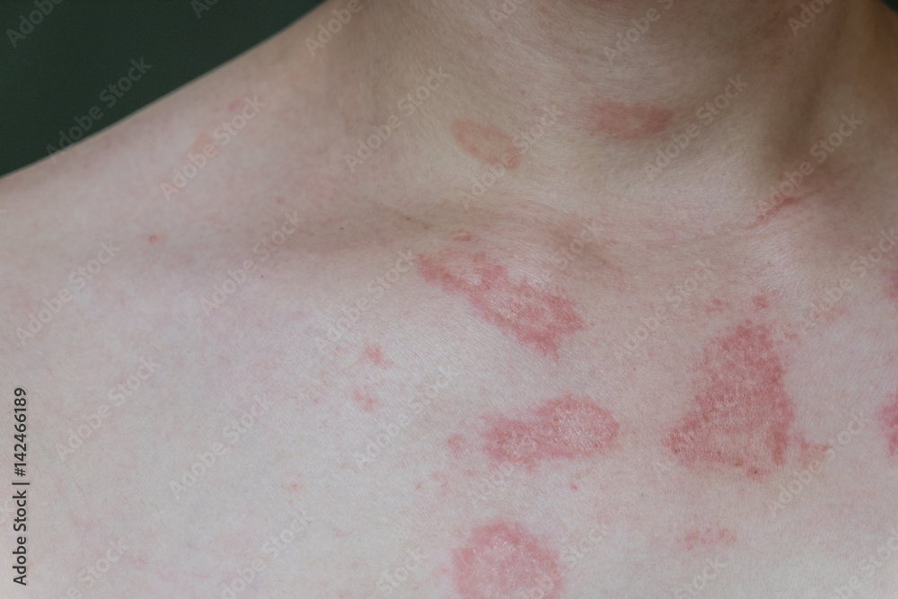 ill allergic rash dermatitis eczema skin of patient,Hot rash ill allergic rash dermatitis eczema skin of patient,Hot rash