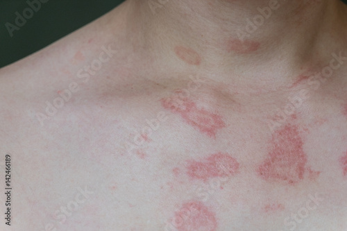 ill allergic rash dermatitis eczema skin of patient,Hot rash