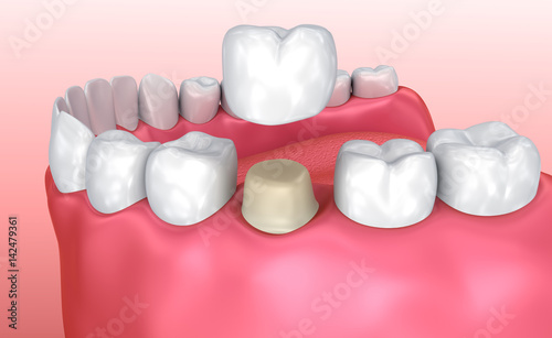 Photography Dental crown installation process, Medically accurate 3d illustration