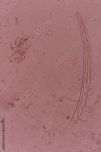 Strongyloides stercoralis