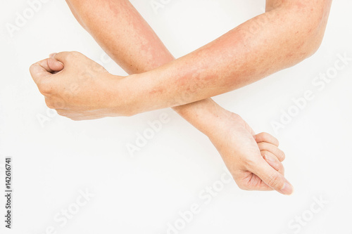 Skin rashes, allergies contact dermatitis ,allergic to chemicals ,fungal infections from exposure photo