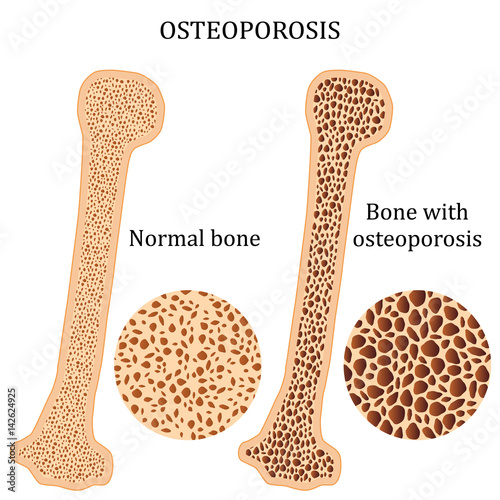 Healthy bone and osteoporosis bone.