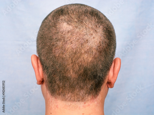 Foto Seborrheic dermatitis. inflammatory changes of the skin.