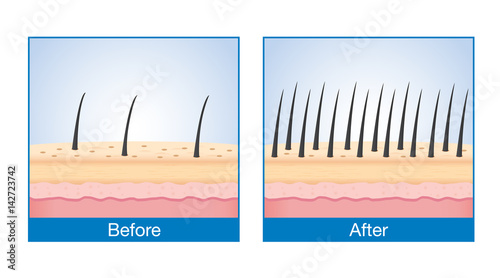 Number of Hair on scalp before and after of treatment hair loss.