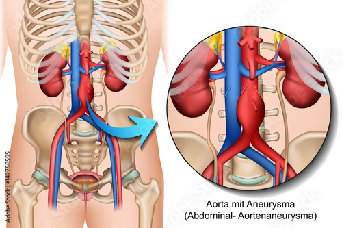 Anatomie Bauchaortenaneurysma, Abdominales Aortenaneurysma illustration photo