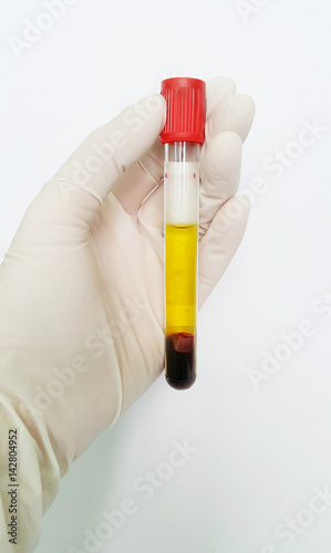 Hand in glove holding normal or yellow serum in clot blood tube. It is good specimen for chemistry and serology test in the laboratory on white backgrounds.