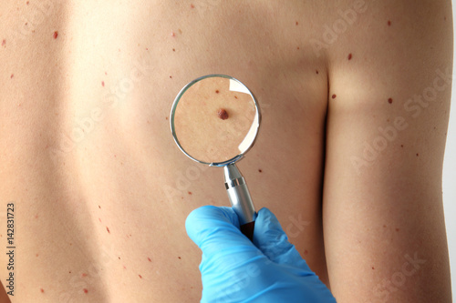 Dermatologist with magnifier examining patient in clinic, closeup