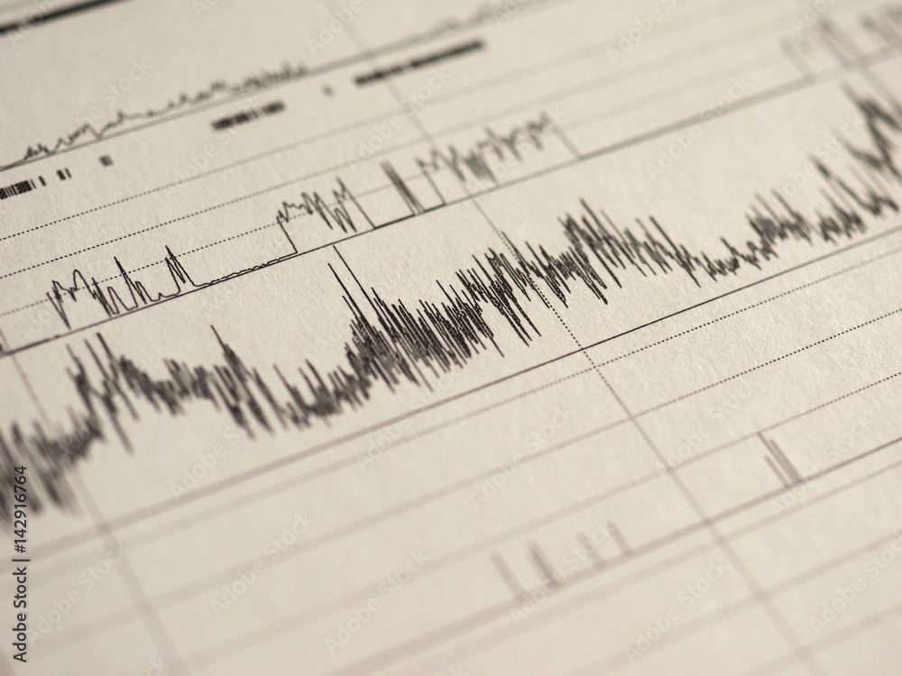 polysomnography (PSG) sleep study polysomnography (PSG) sleep study