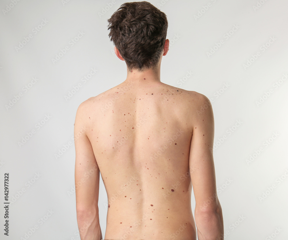 Fototapeta premium Young man with birthmarks on light background