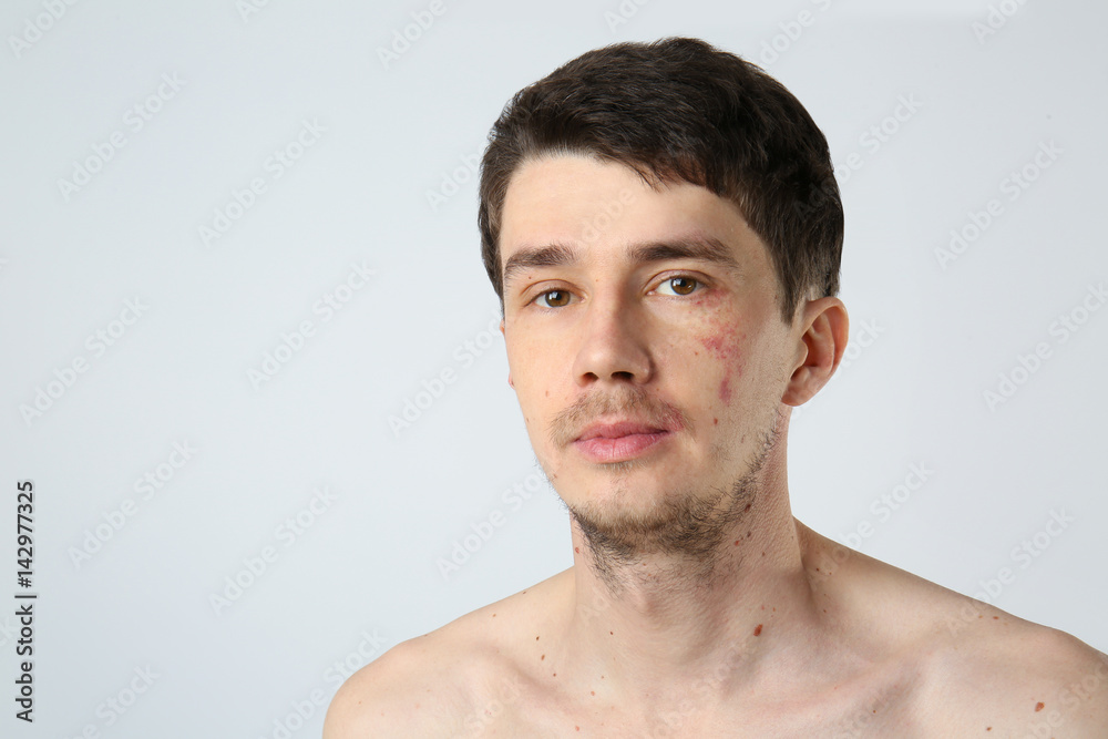 Young man with birthmarks on light background Young man with birthmarks on light background