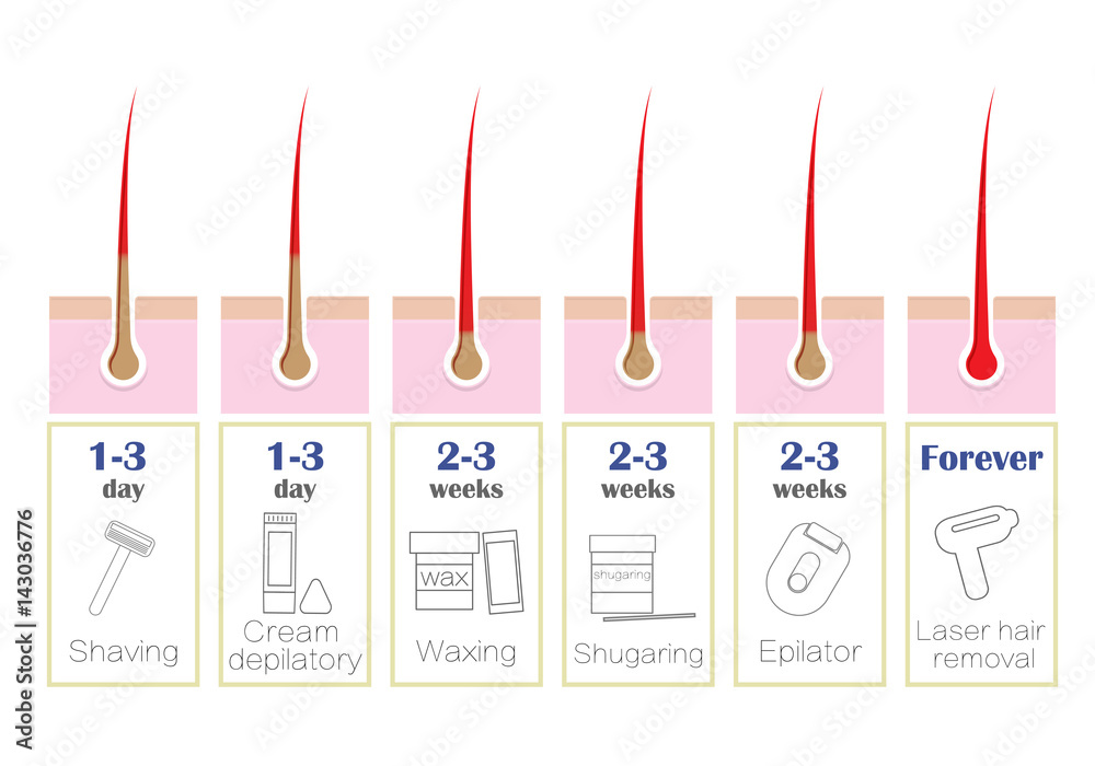 Comparison of the popular methods of hair removal: laser, epilator, waxing,  shaving, shugaring, Stock Vector | Adobe Stock