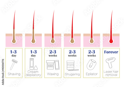 Comparison of the popular methods of hair removal: laser, epilator, waxing, shaving, shugaring,