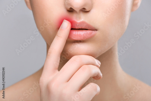 Woman with cold sore touching lips on light background photo