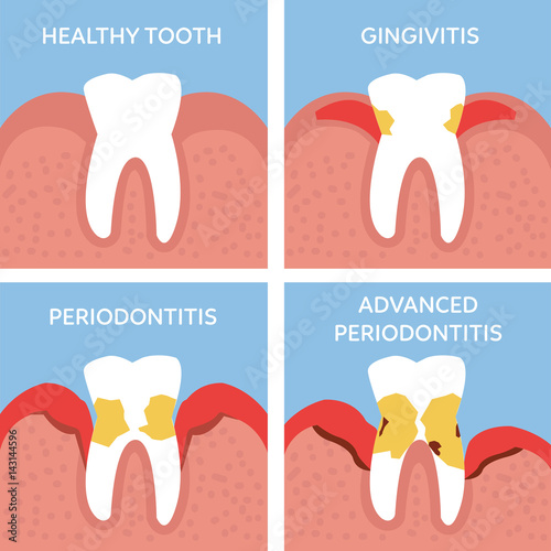 periodontitis photo