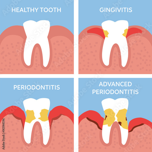 periodontitis