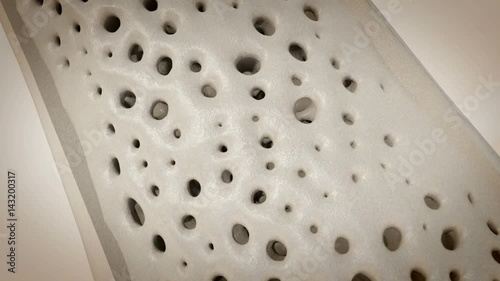 Osteoporosis animation