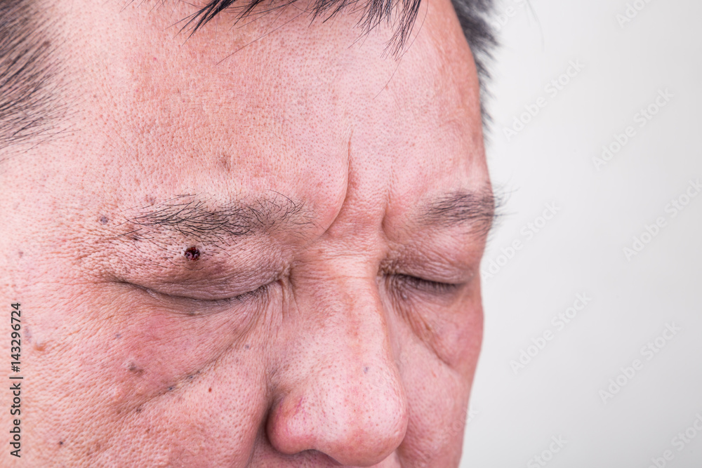 Mole removed via skin graft procedure leaving scar