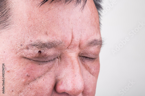 Photos Mole removed via skin graft procedure leaving scar