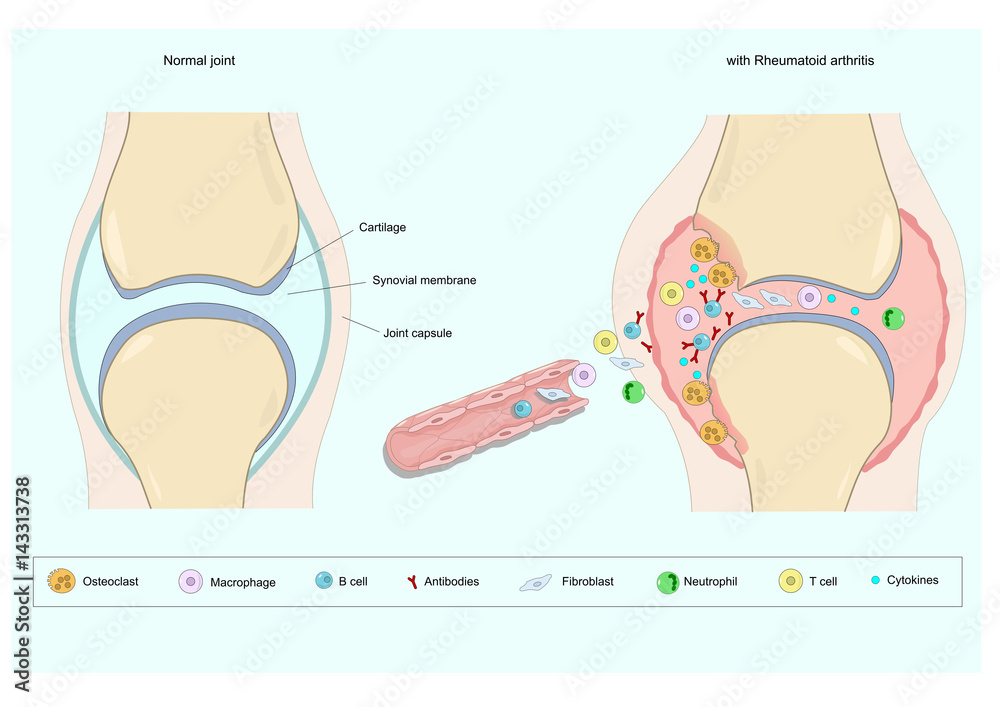Section of a normal joint and one with rheumatoid arthritis