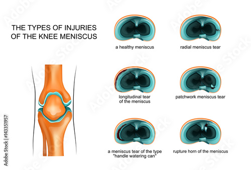 types of meniscus tear photo