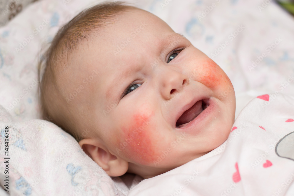 Cute baby with eczema on her face crying in pain Stock Photo Adobe Stock