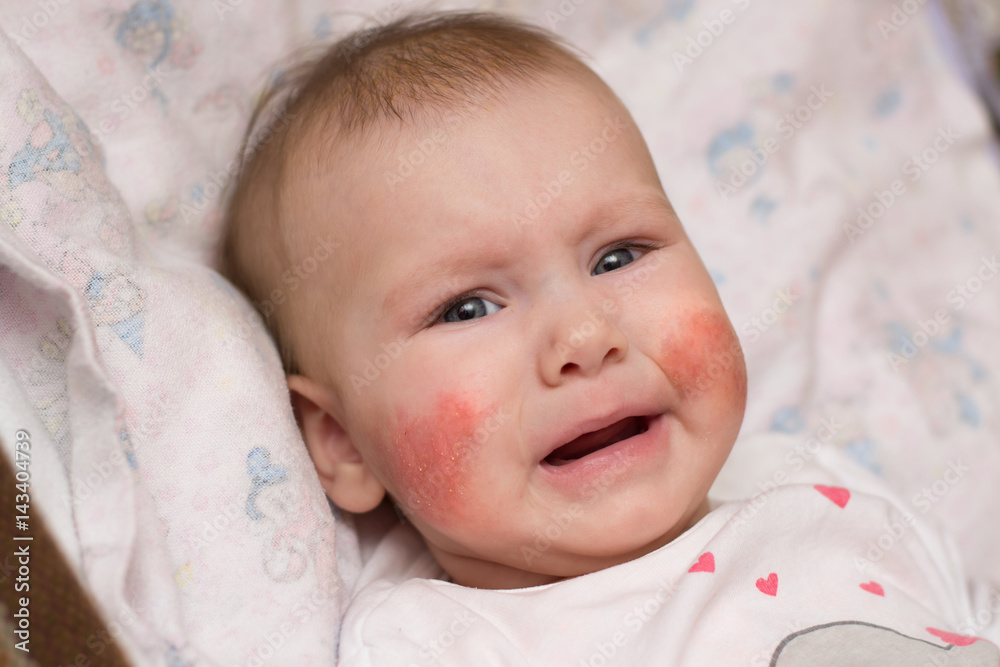 Cute baby with eczema on her face crying in pain Cute baby with eczema on her face crying in pain