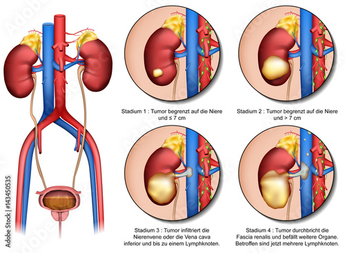Anatomie der Niere und Stadien Nierenkrebs, vektor illustration mit Beschreibung deutsch photo