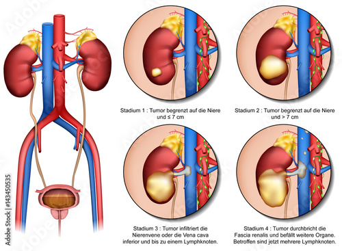 Anatomie der Niere und Stadien Nierenkrebs, vektor illustration mit Beschreibung deutsch