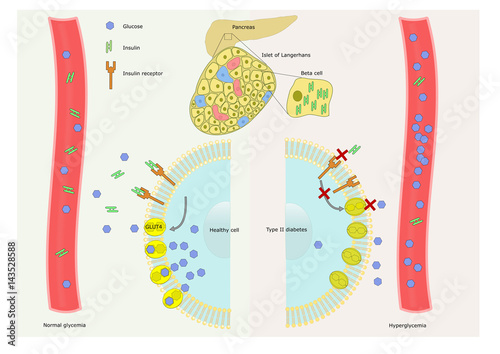 diabetes and mechanism of insulin resistance