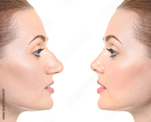 Young woman before and after rhinoplasty on white background. Plastic surgery concept photo