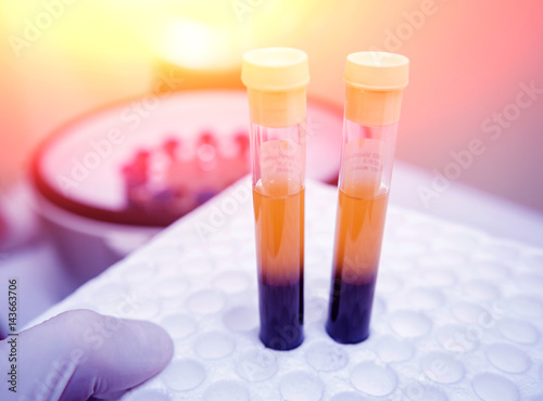 Platelet-Rich plasma preparation. Tube with blood in hands. Centrifuge. photo