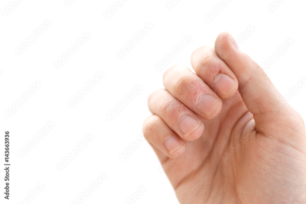 Bitten fingers close-up on a white background. Terribly badly bitten fingers of a hand. Stress. Nervousness. Habit. Depression. Till blood. Mutilated. Isolate Bitten fingers close-up on a white background. Terribly badly bitten fingers of a hand. Stress. Nervousness. Habit. Depression. Till blood. Mutilated. Isolate