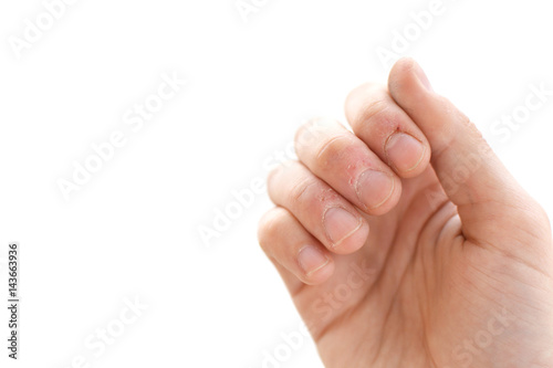 Bitten fingers close-up on a white background. Terribly badly bitten fingers of a hand. Stress. Nervousness. Habit. Depression. Till blood. Mutilated. Isolate