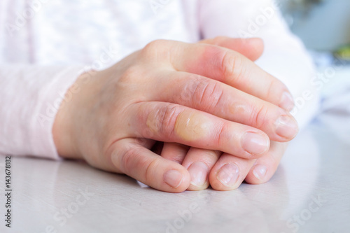 hand with second degree burns