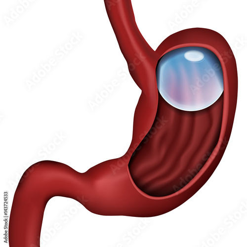 Gewichtsreduktion mit der Ballon Therapie, vektor illustration