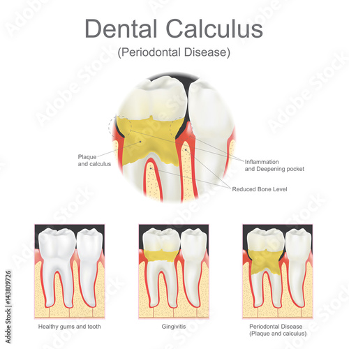 Dental calculus periodontal disease.