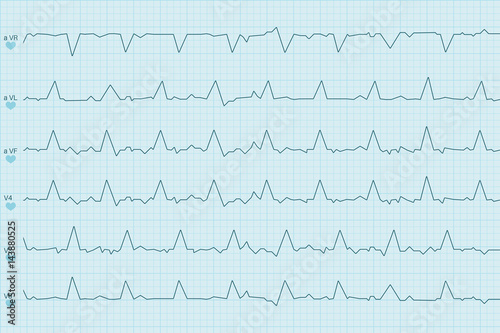 Electrocardiogram test results. Curves on blue paper