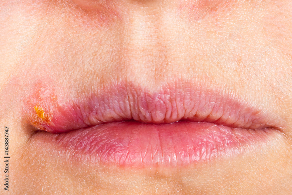 Herpes on the lip close up macro Herpes on the lip close up macro