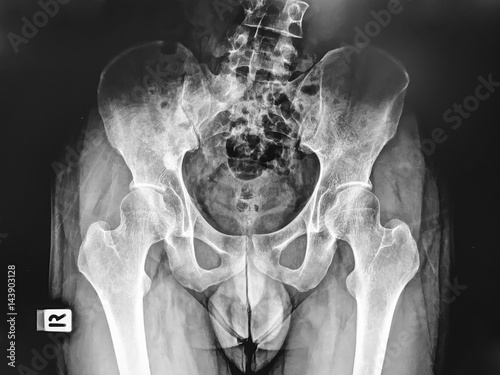 X-ray film of pelvis from person with scoliosis, a curvature of spine