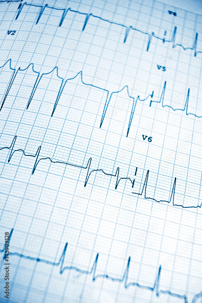 Electrocardiogram Electrocardiogram