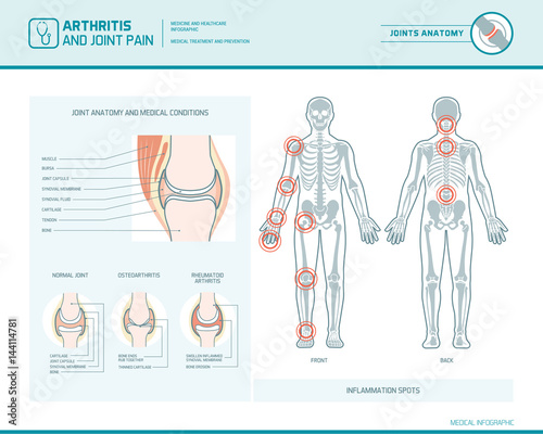 Arthritis and joint pain infographic