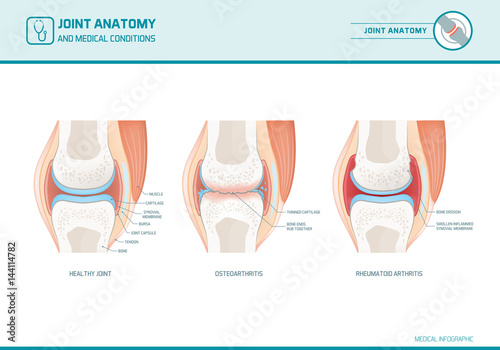 Joint anatomy, osteoarthritis and rheumatoid arthritis infographic photo